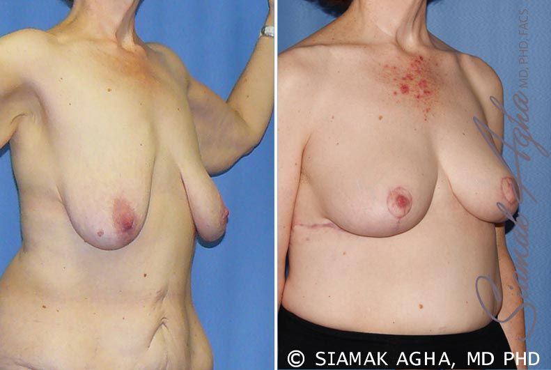 Breast Lift Before & After
