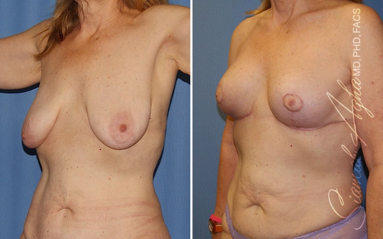 Breast Lift Before & After