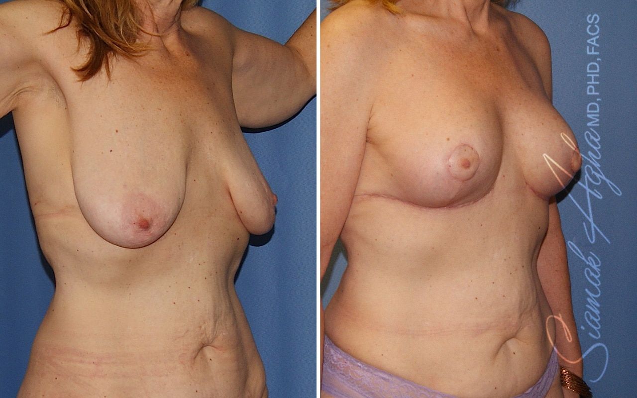 Breast Lift Before & After