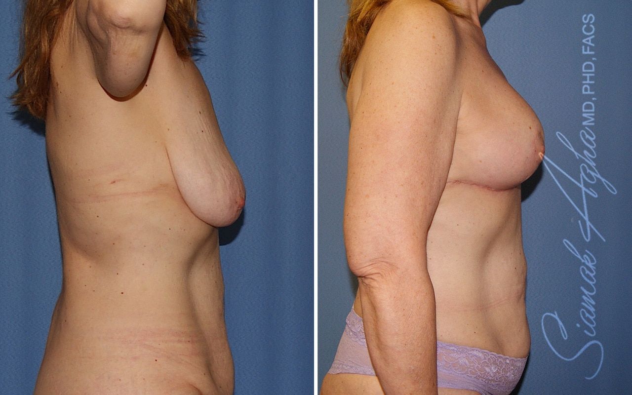 Breast Lift Before & After