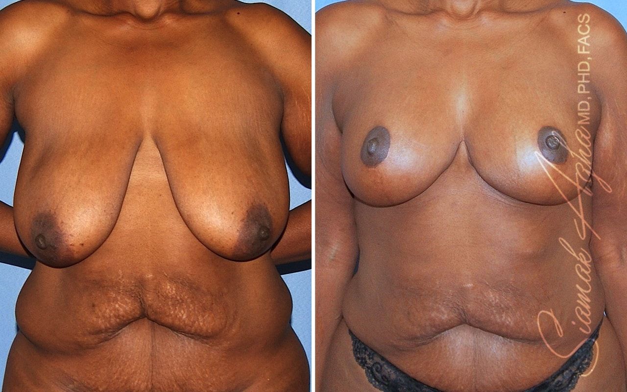 Breast Lift Before & After