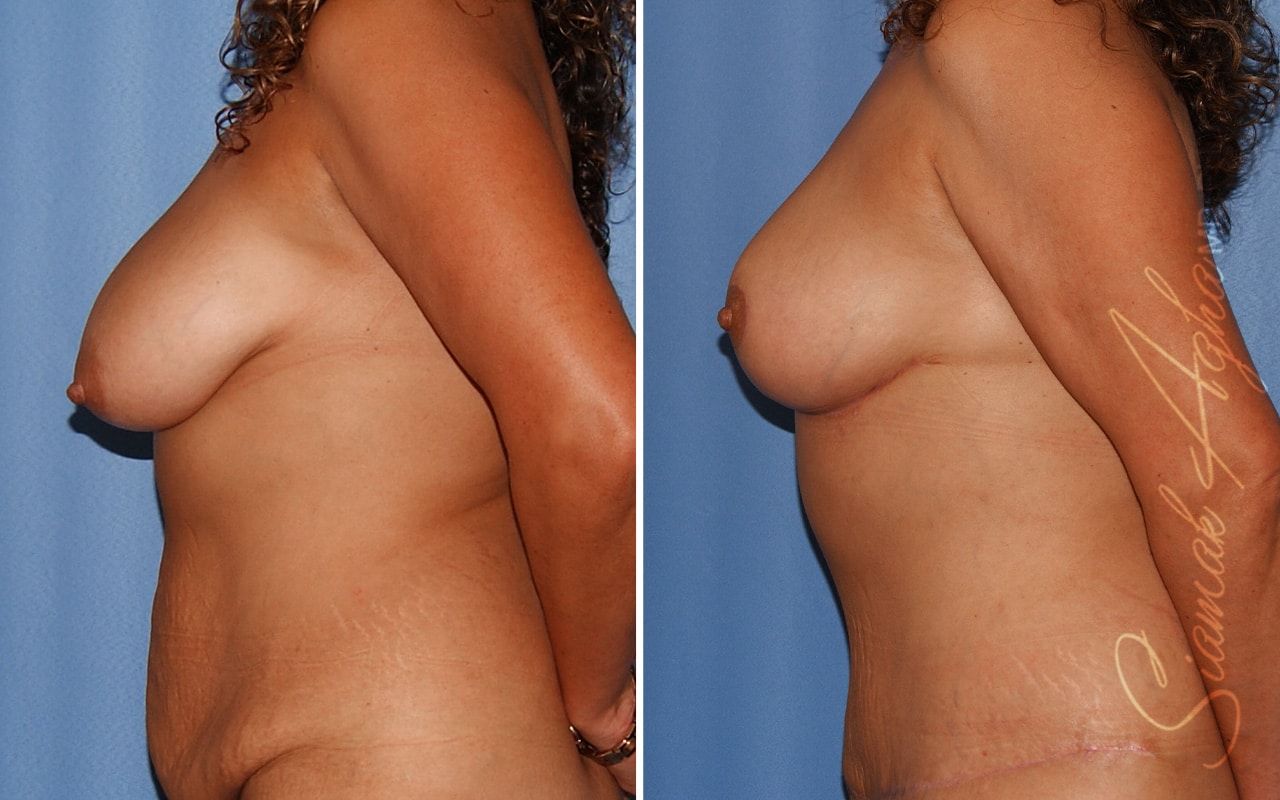 Breast Lift Before & After