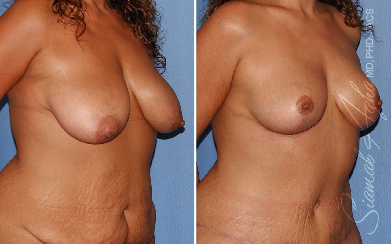 Breast Lift Before & After