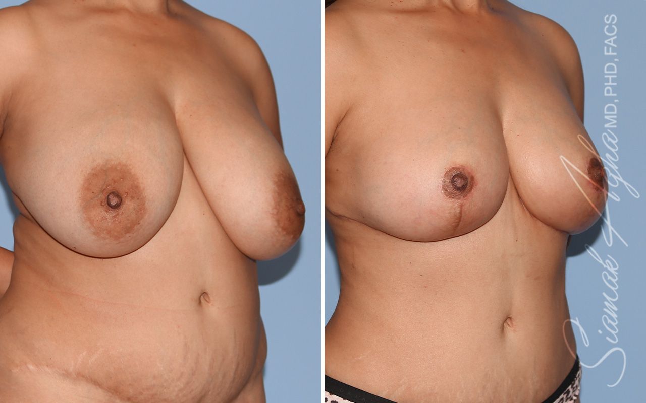 Breast Lift Before & After