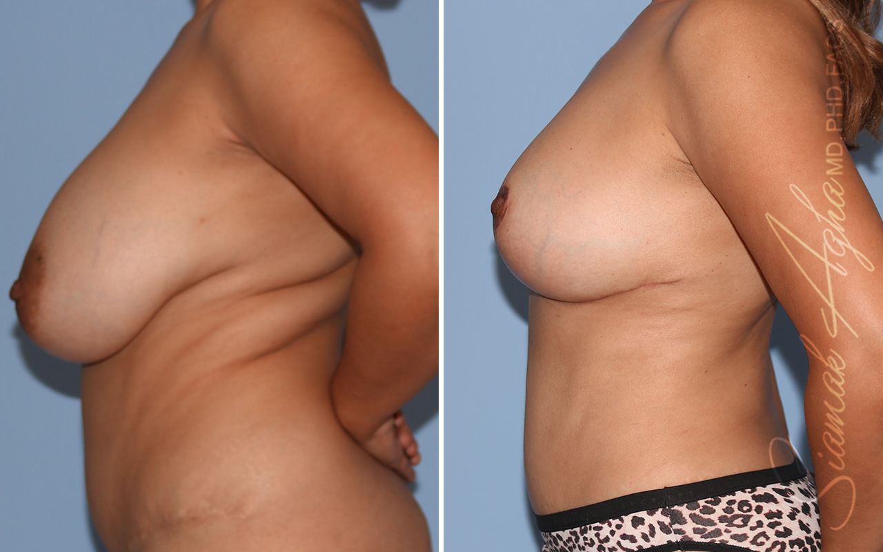 Breast Lift Before & After