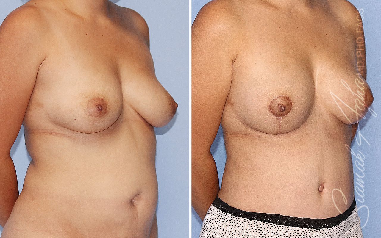 Breast Lift Before & After