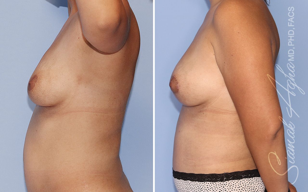 Breast Lift Before & After