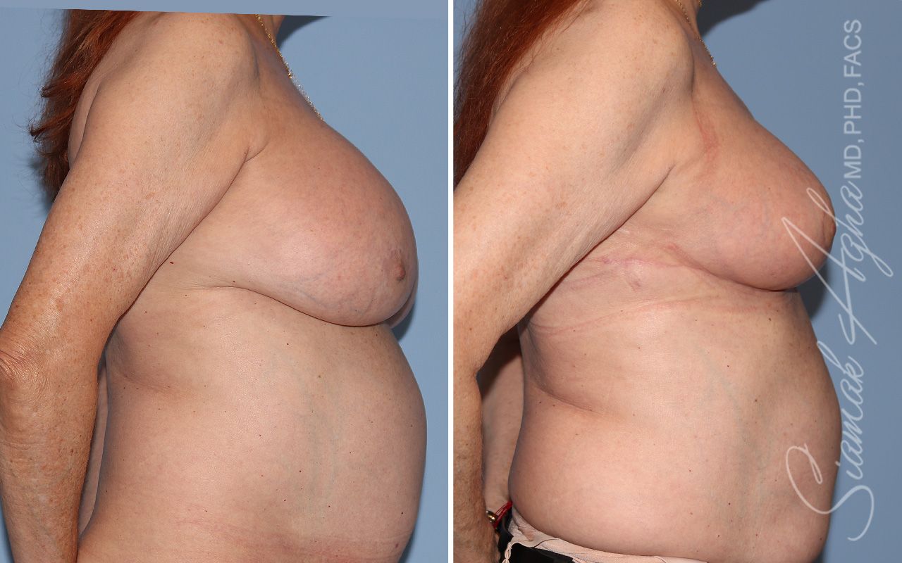 Breast Lift Before & After