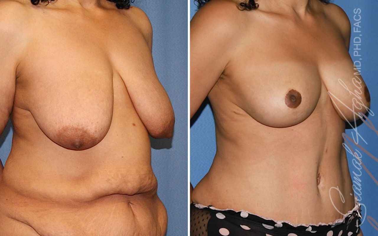 Breast Lift Before & After