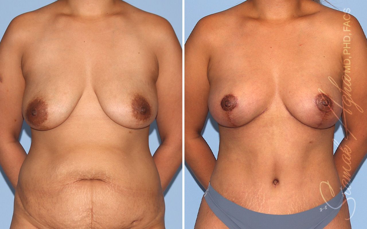 Breast Lift Before & After