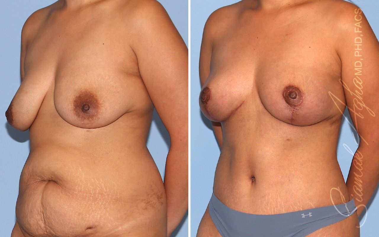 Breast Lift Before & After