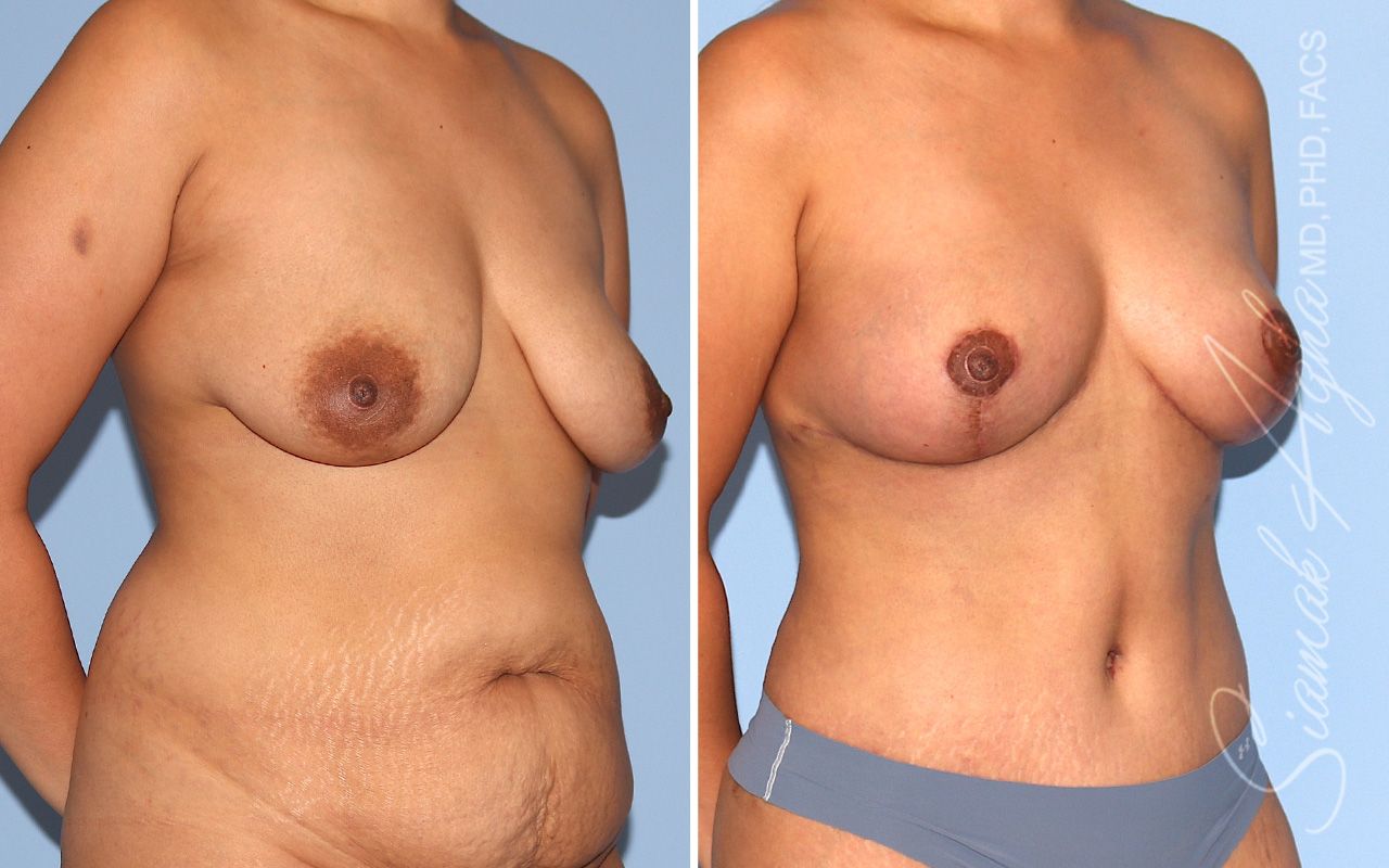 Breast Lift Before & After