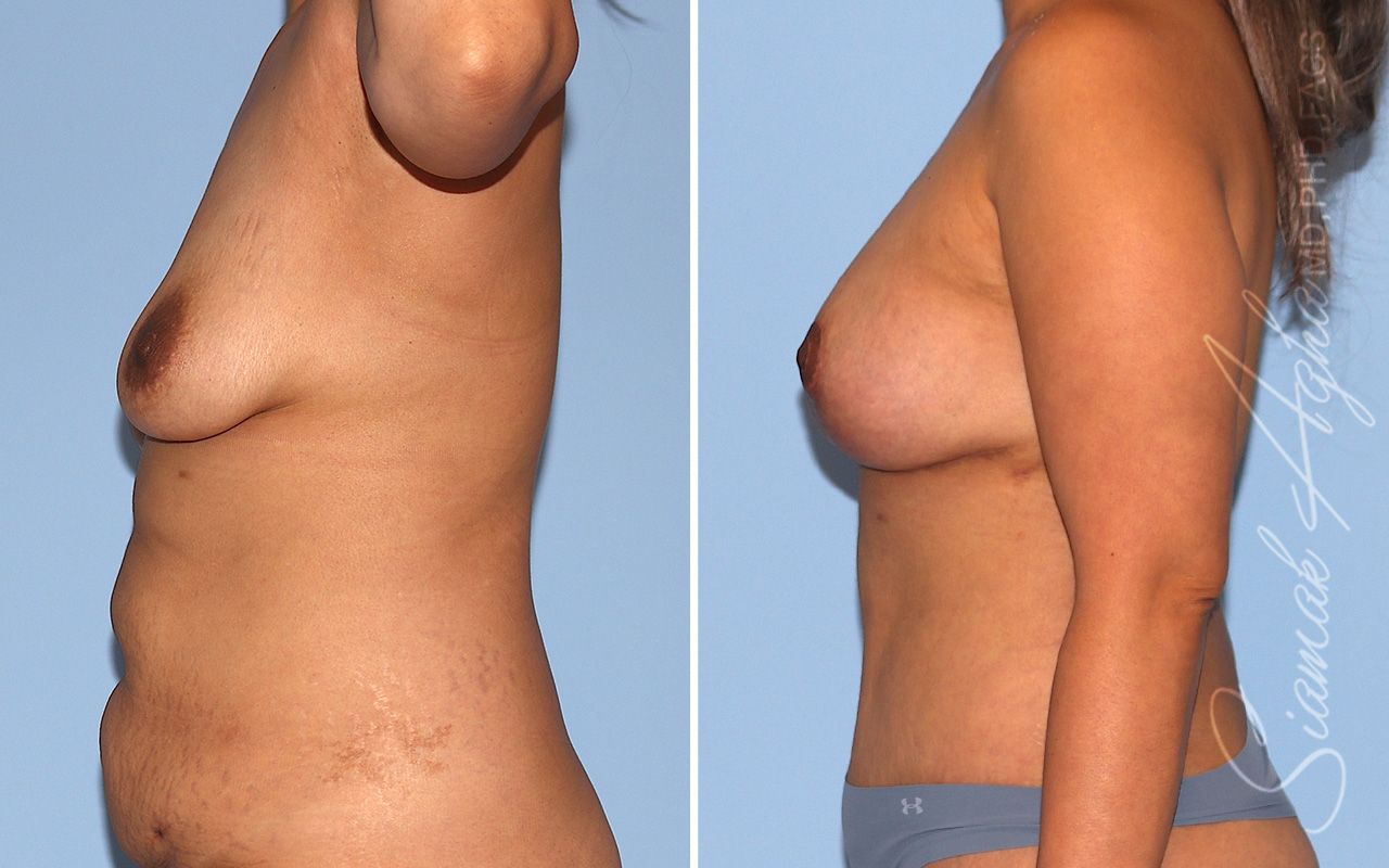 Breast Lift Before & After