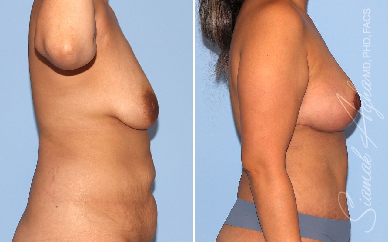 Breast Lift Before & After