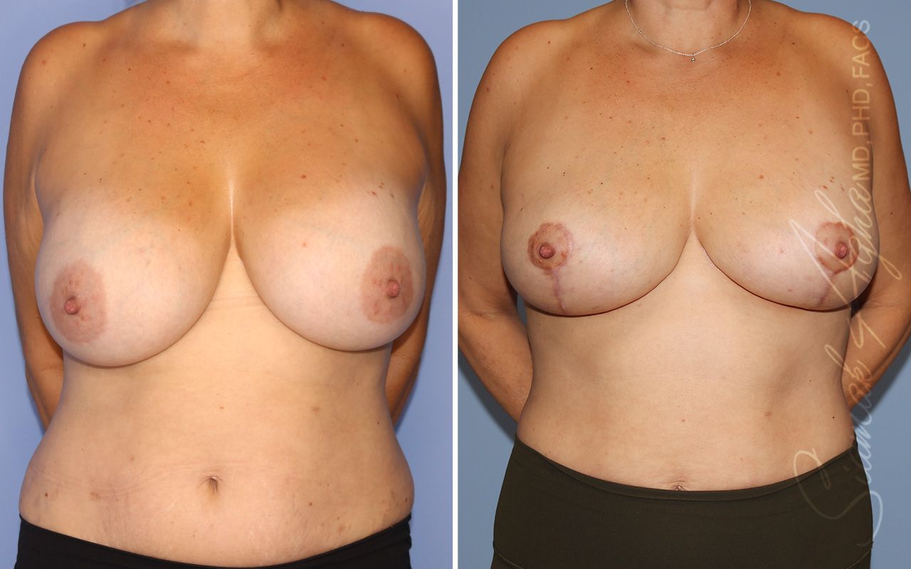 Breast Lift Before & After