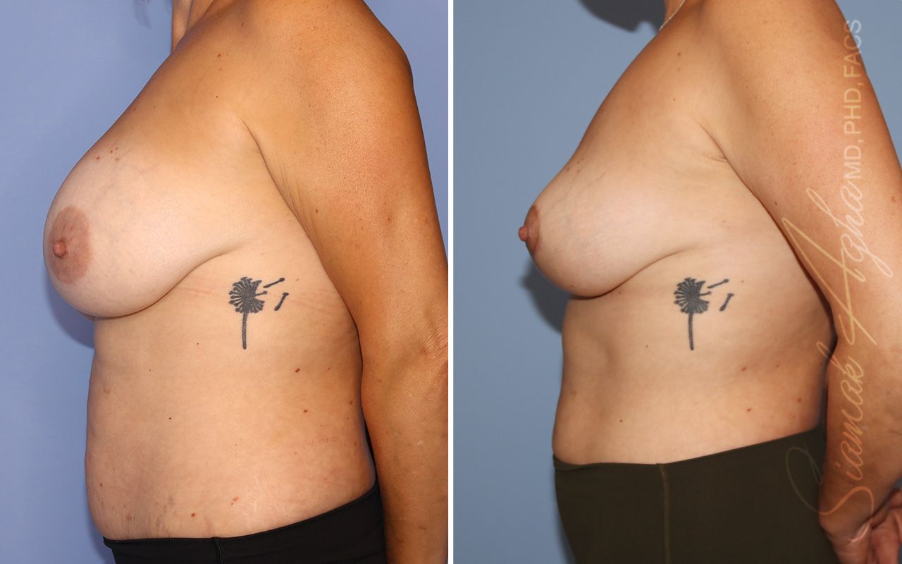 Breast Lift Before & After