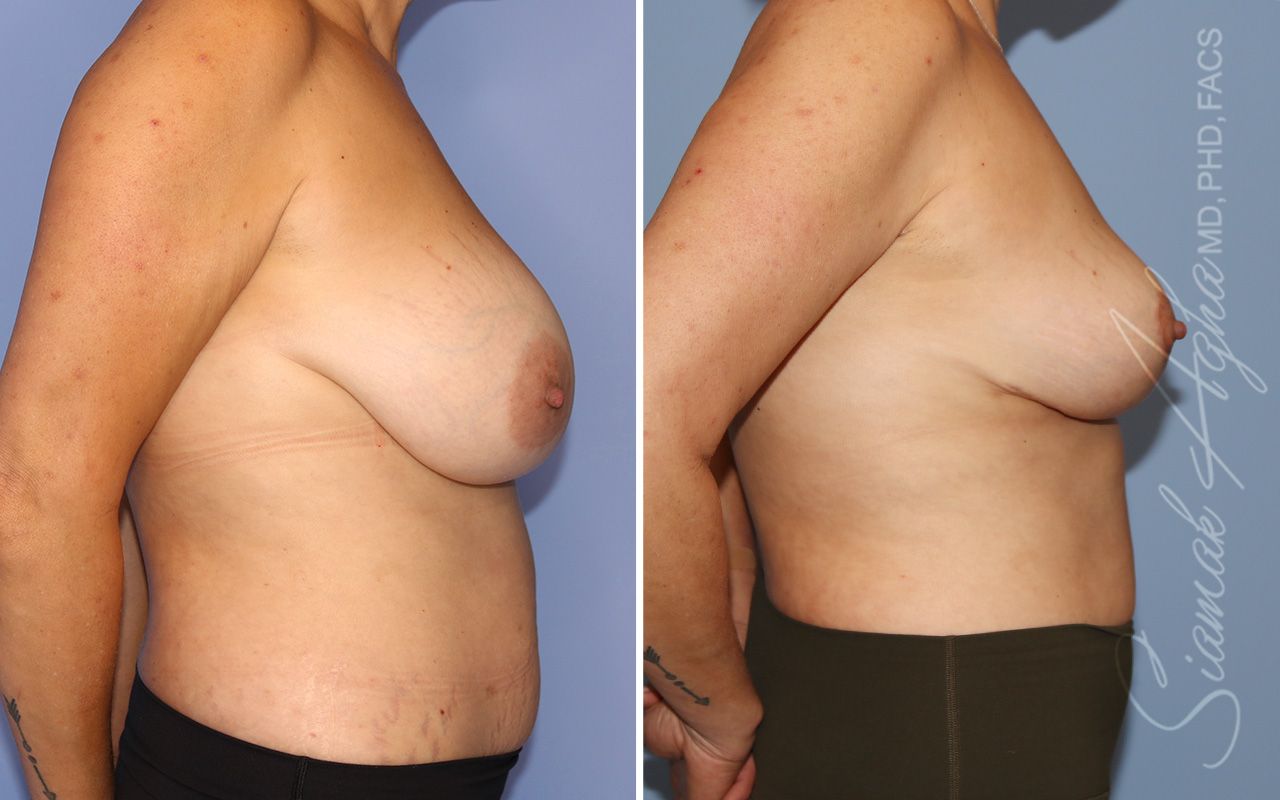 Breast Lift Before & After