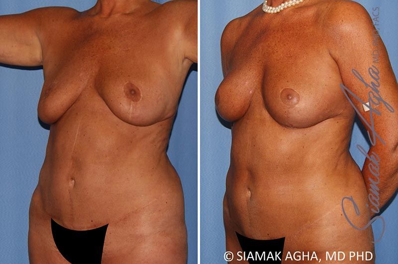 Breast Lift Before & After