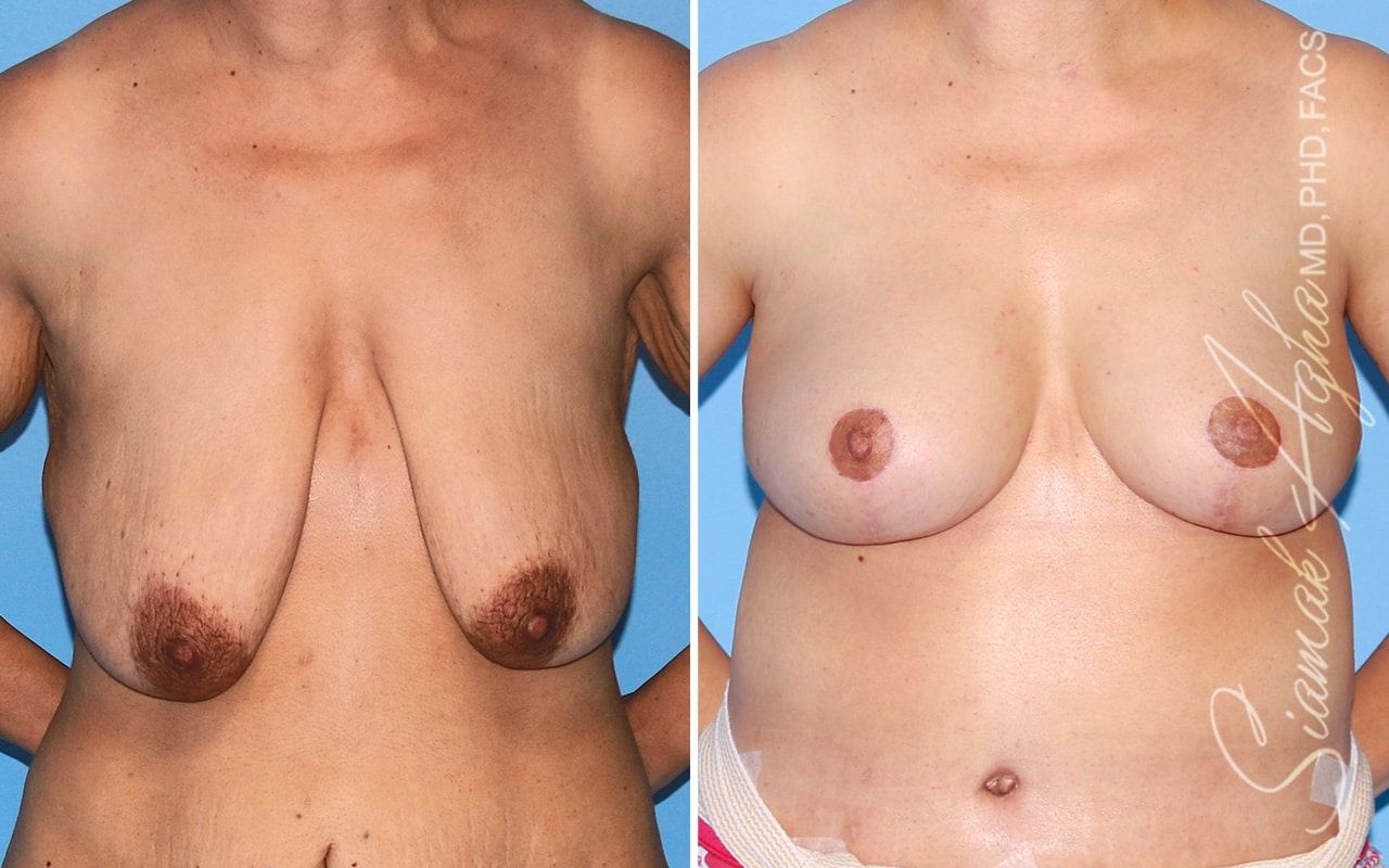 Breast Lift Before & After