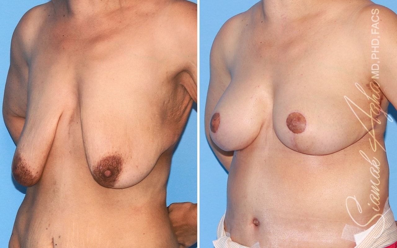 Breast Lift Before & After