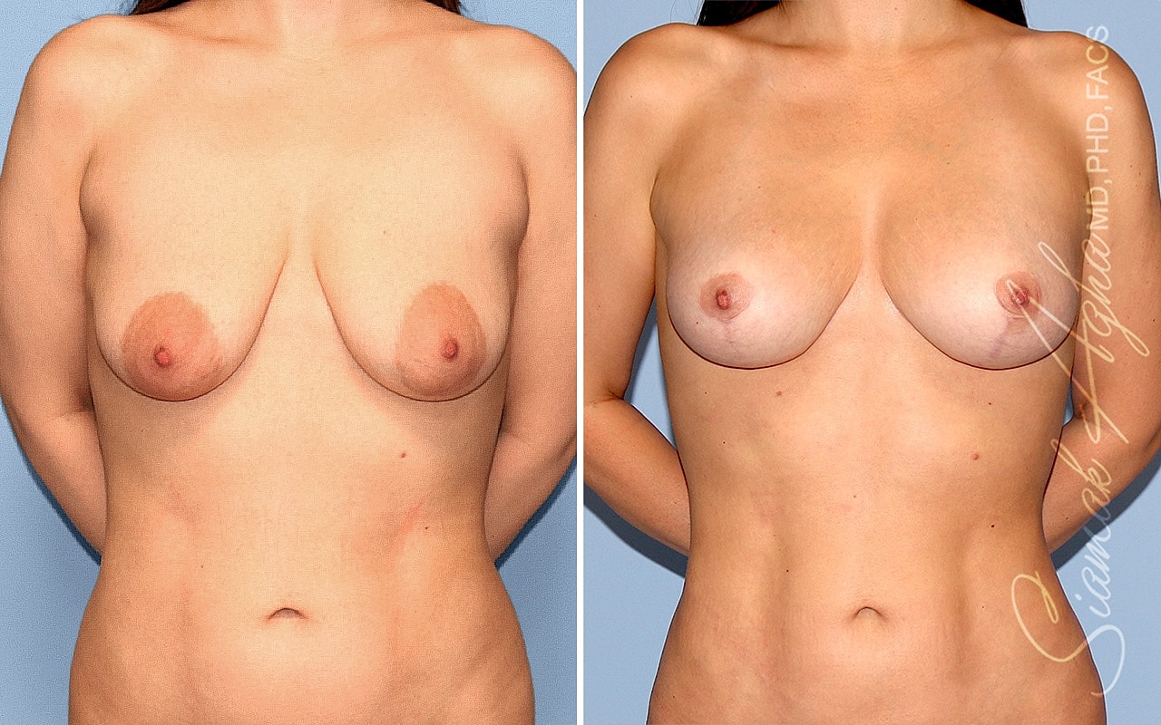 Breast Lift Before & After