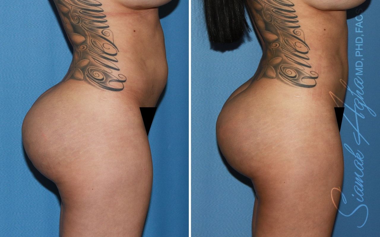 Buttock Correction Before & After
