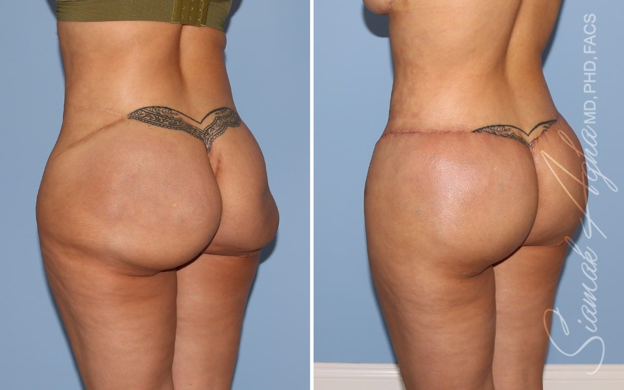 Buttock Correction Before & After
