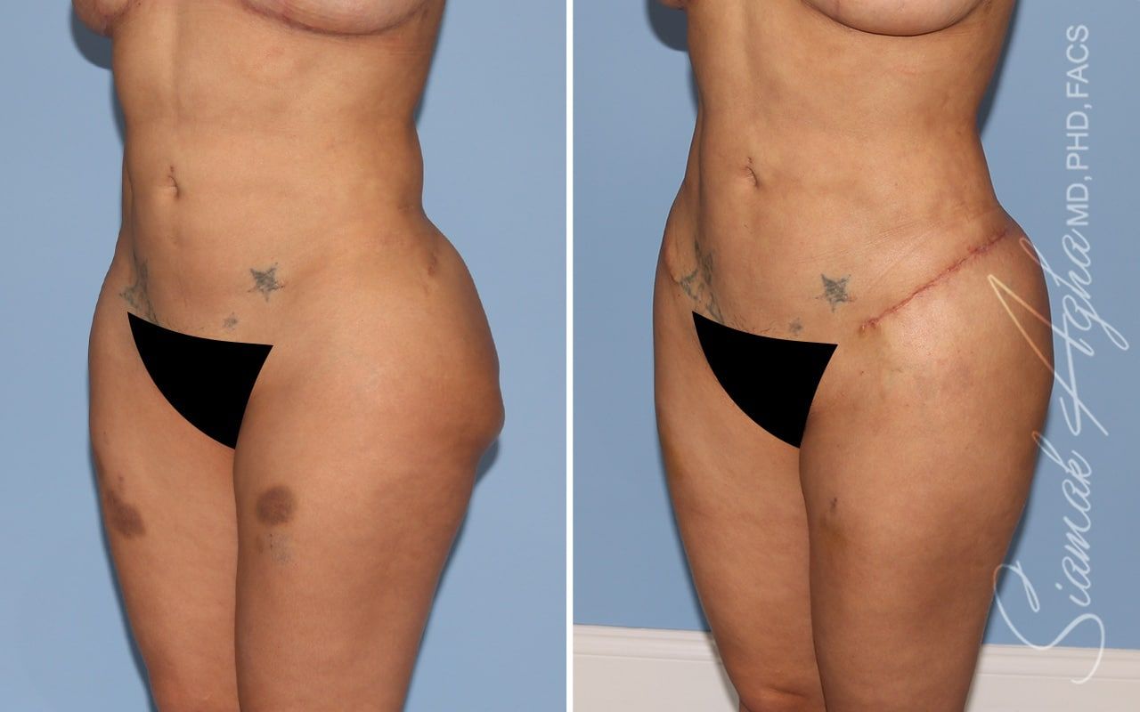 Buttock Correction Before & After