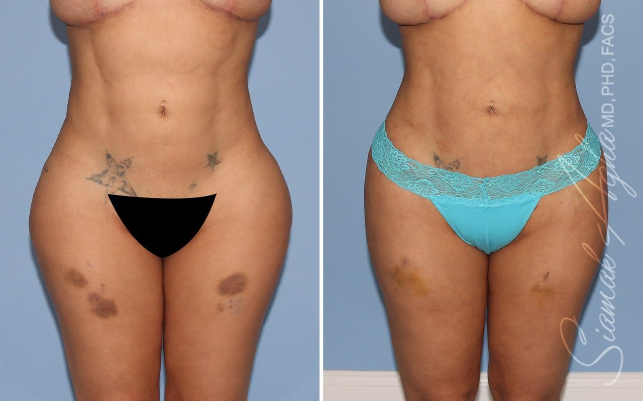 Buttock Correction Before & After