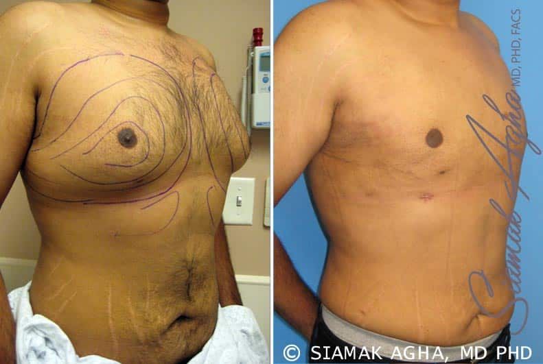 Liposuction Before & After