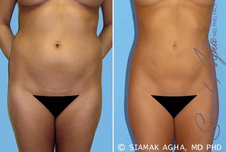 Liposuction Before & After