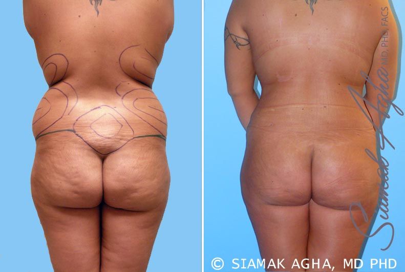Liposuction Before & After