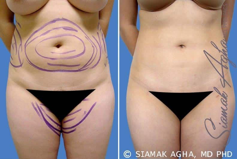 Liposuction Before & After
