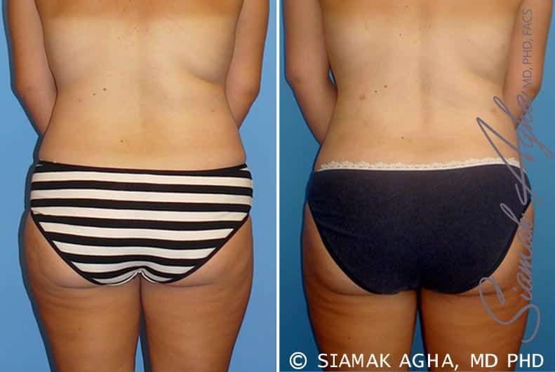 Liposuction Before & After