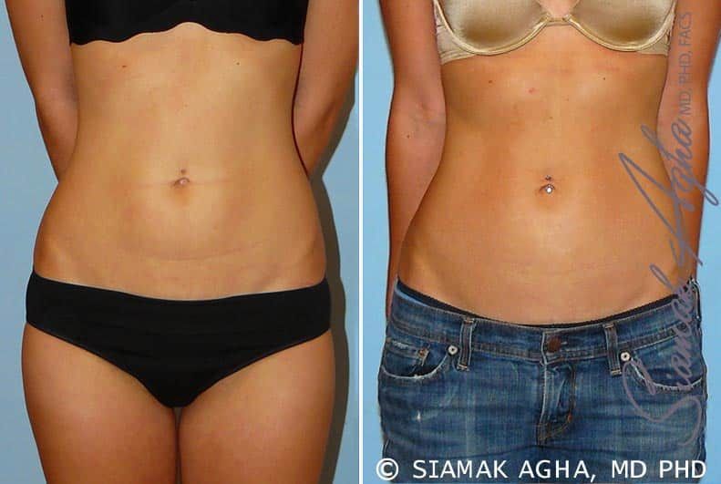 Liposuction Before & After