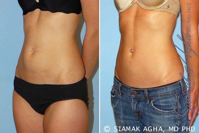 Liposuction Before & After