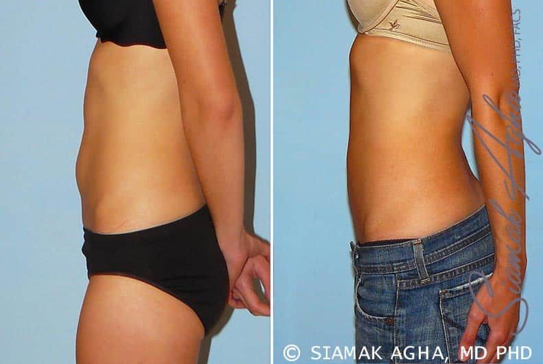 Liposuction Before & After
