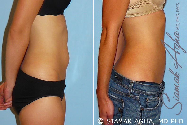 Liposuction Before & After