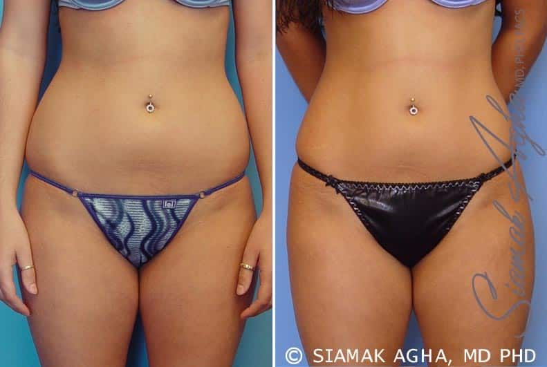 Liposuction Before & After