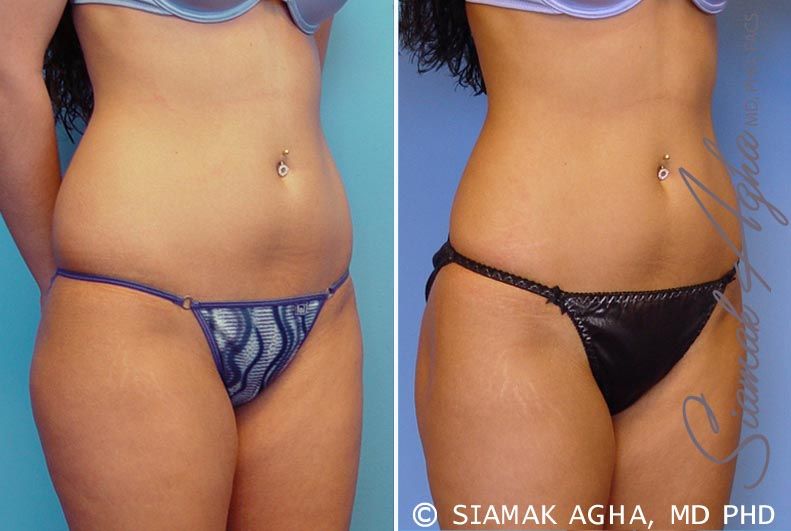 Liposuction Before & After