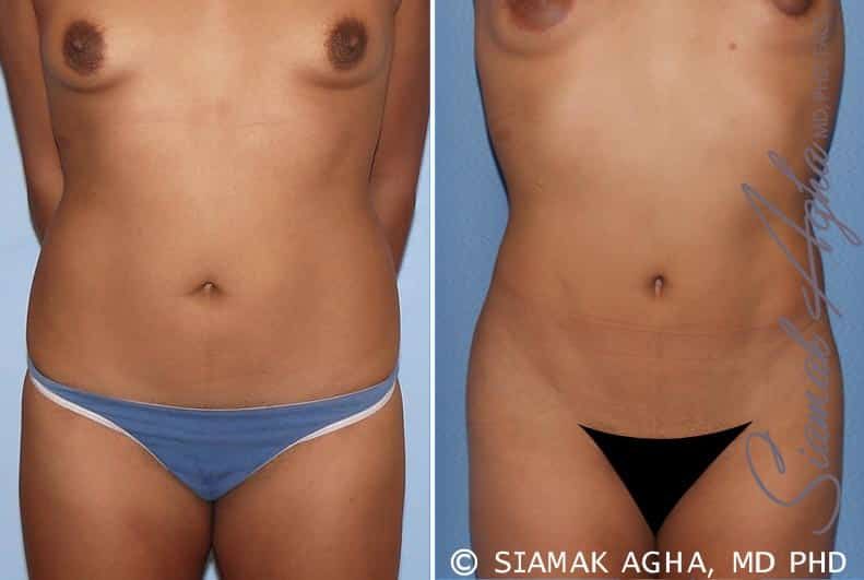 Liposuction Before & After