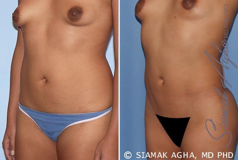 Liposuction Before & After