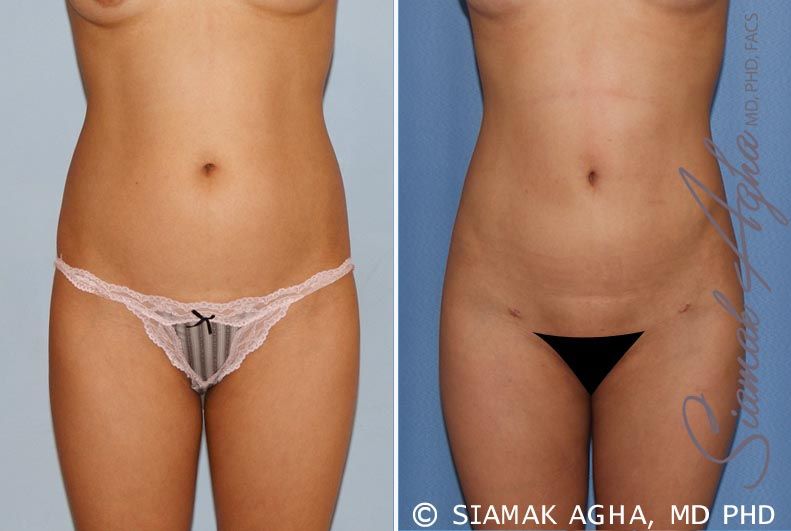 Liposuction Before & After