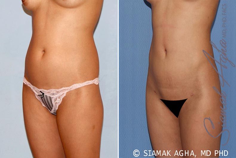 Liposuction Before & After