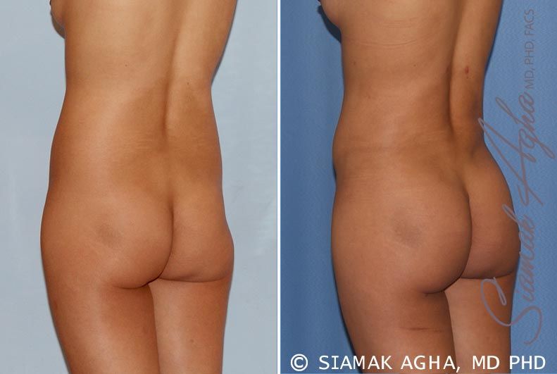 Liposuction Before & After