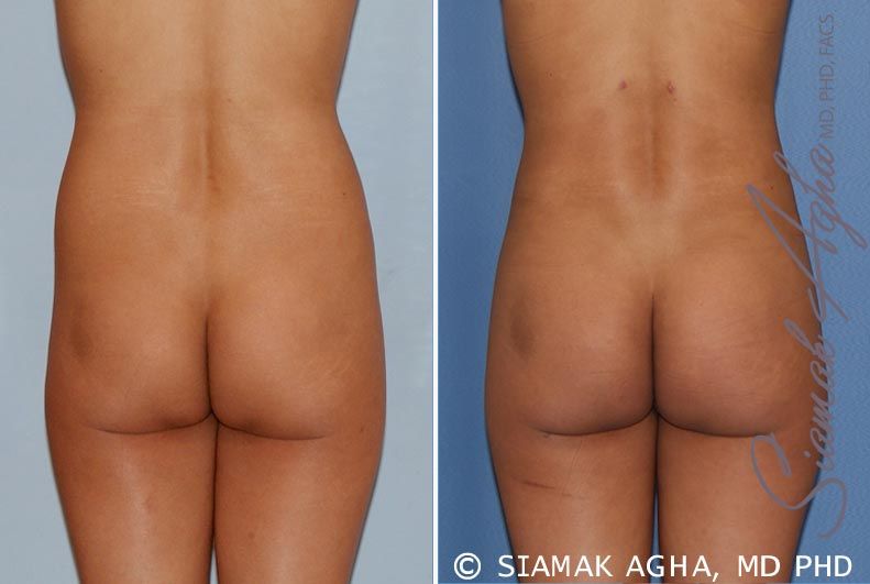 Liposuction Before & After