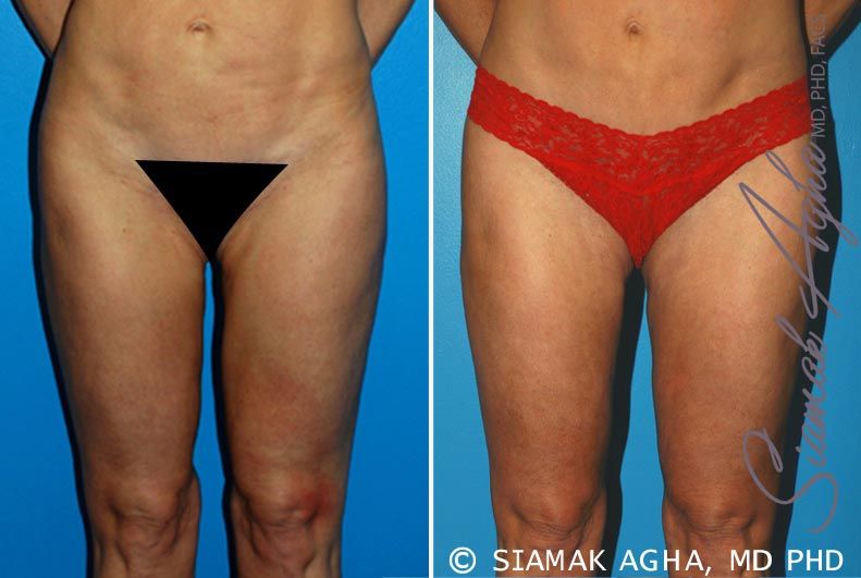 Liposuction Before & After