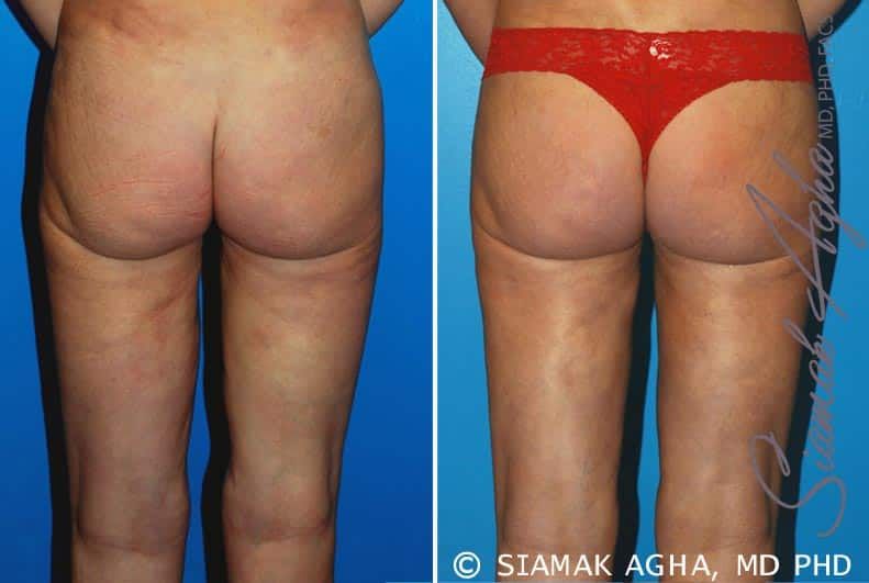 Liposuction Before & After