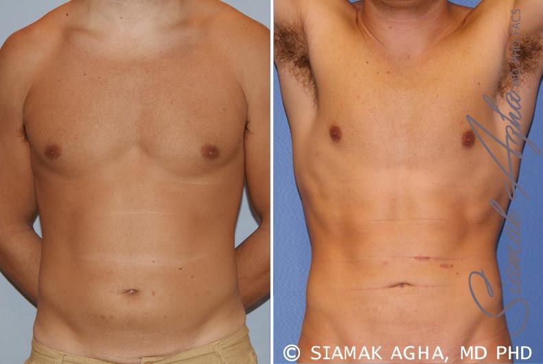 Liposuction Before & After