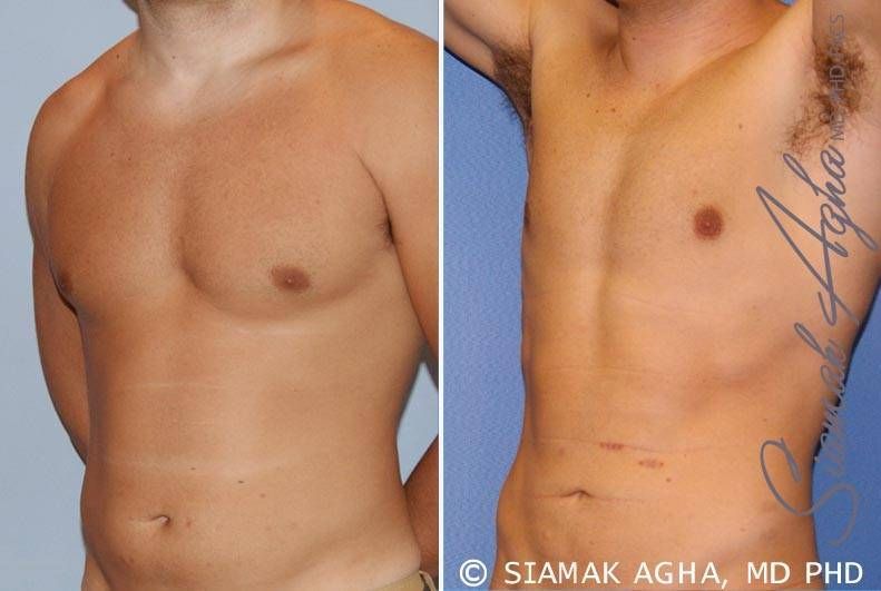 Liposuction Before & After
